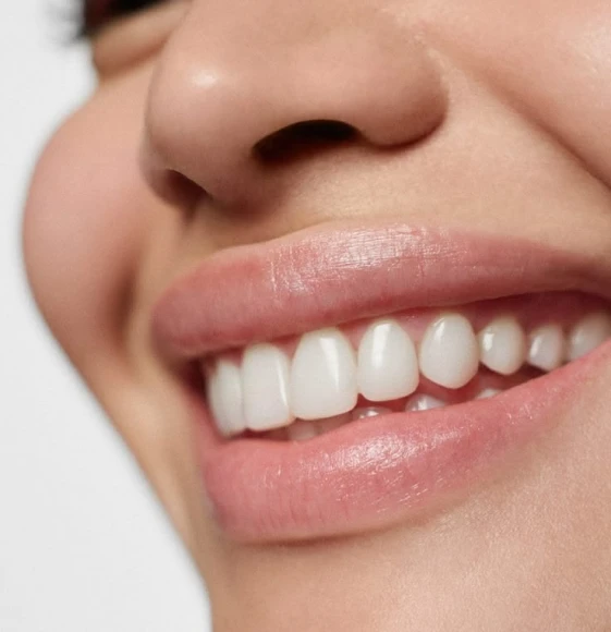 Sourire éclatant après un éclaircissement dentaire