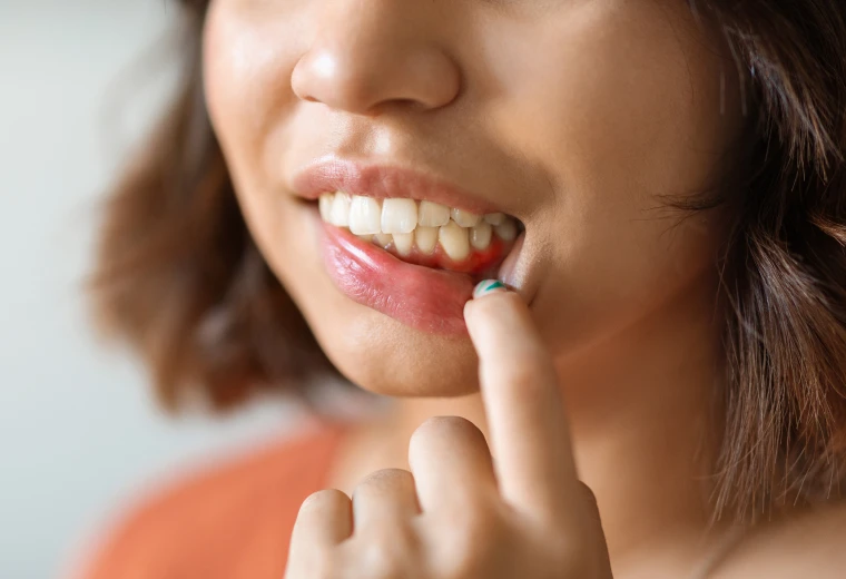 Gencive enflammée, signe d'inflammation gingivale