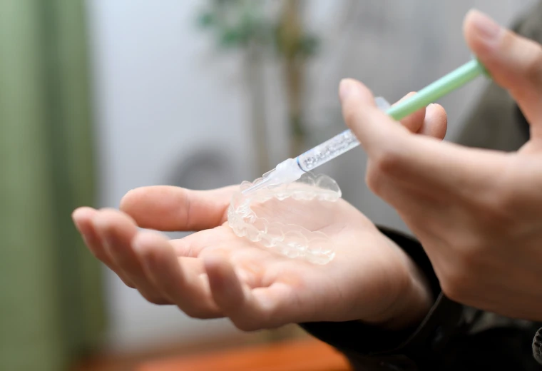 Application du gel dans une gouttière d'éclaircissement dentaire