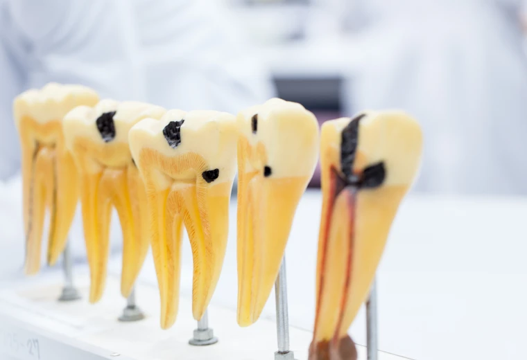 Modèles anatomiques de dents montrant différents stades de carie dentaire